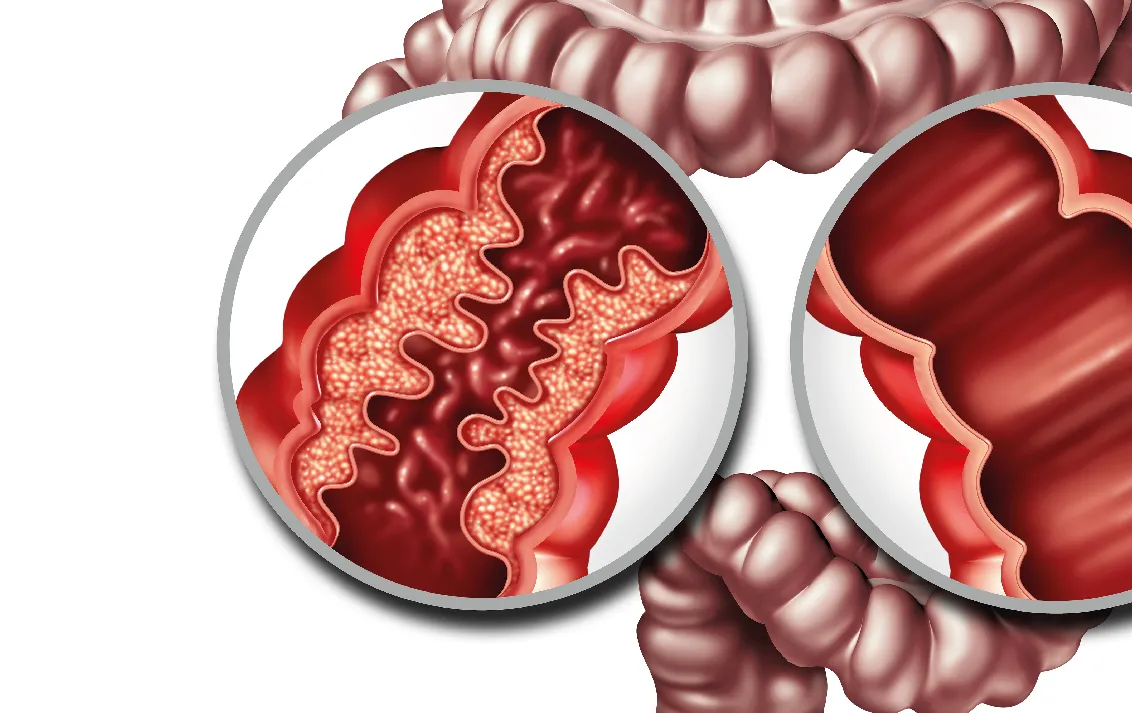 Doença de Crohn